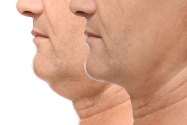 HIFU - Breakthrough in Anti - ageing 2 hifu results Bognor Regis