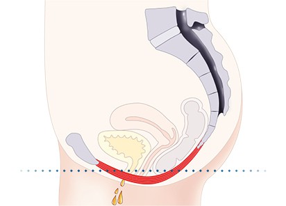 Pelvic-Floor Muscle Repair 5 Pelvic floor muscles Bognor Regis