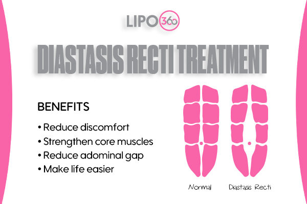 Revolutionising Muscle Repair: The Power of LIPO360 Body Sculpt Post-Injury 5 diastasis recti treatment Bognor Regis