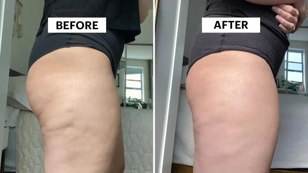 Do Toning Exercise Bognor Regis Really Tackle Cellulite?