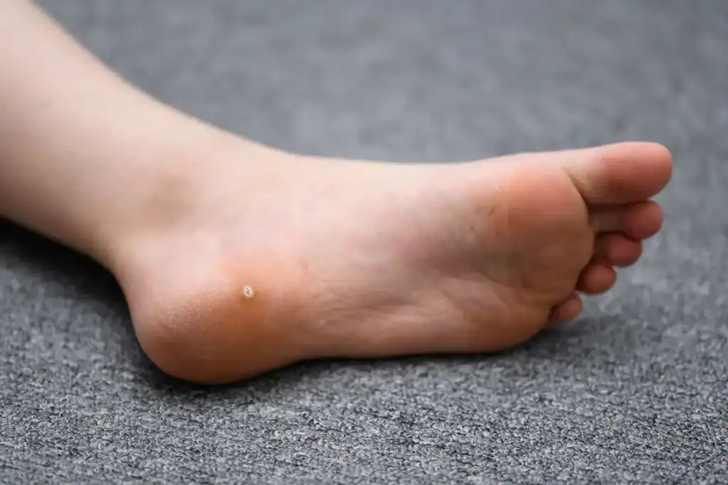 Cryotherapy For Warts And Also Verrucas 2 Image of verruca on the bottom of the foot that able to be treated with Cryotherapy Bognor Regis