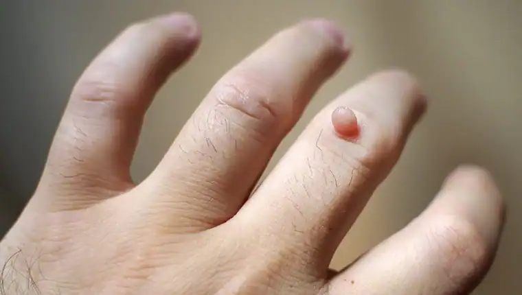 Image of blemish that Cryotherapy Bognor Regis can remove with Lipo 360.