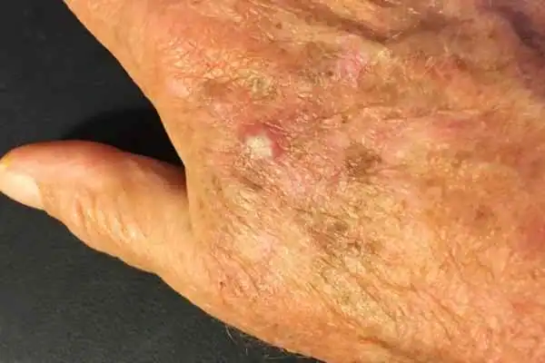 Image of Actinic keratoses Bognor Regis on a person hand