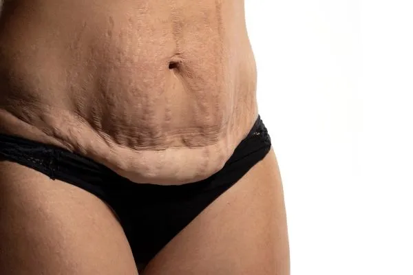 The science behind skin tightening Bognor Regis picture of a woman's sagging skin on the stomach